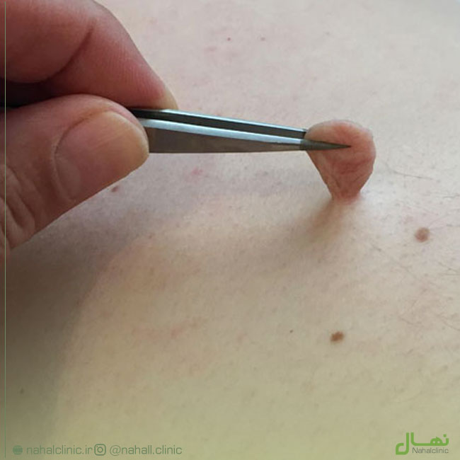 منگوله‌های پوستی