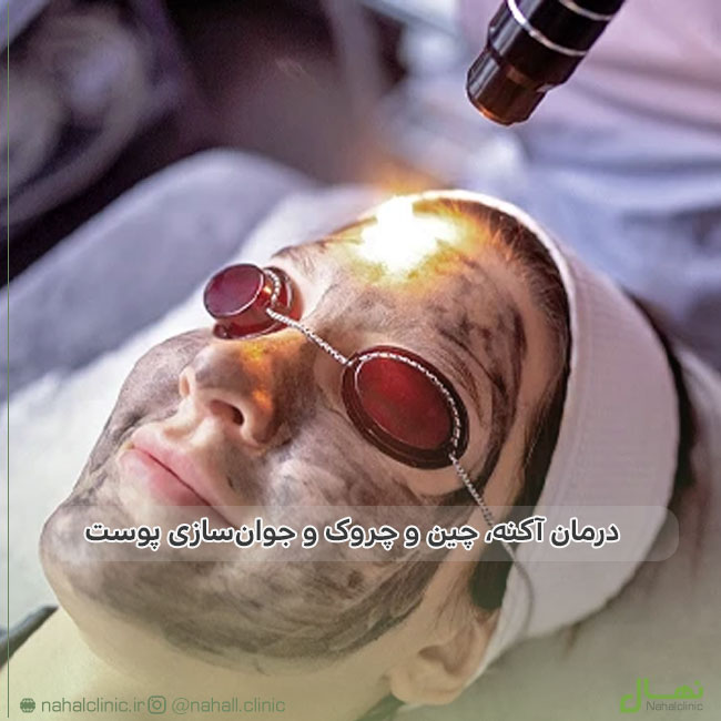 کربن تراپی