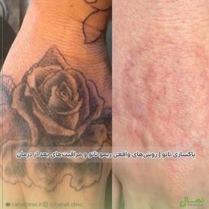 پاکسازی تاتو | روشهای واقعی ریمو تاتو و مراقبتهای بعد از درمان
