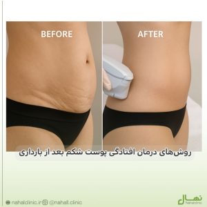روشهای درمان افتادگی پوست شکم بعد از بارداری