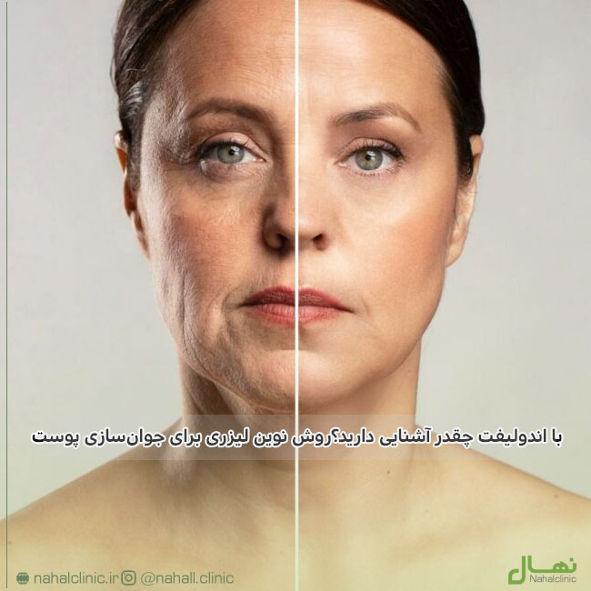 اندولیفت