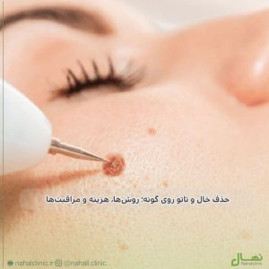 حذف خال و تاتو روی گونه | بهترین روشهای لیزر، جراحی و درمان 2025
