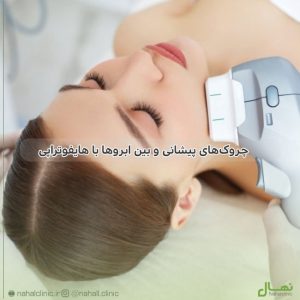 چروکهای پیشانی و بین ابروها با هایفوتراپی: روشی نوین برای جوانسازی پوست