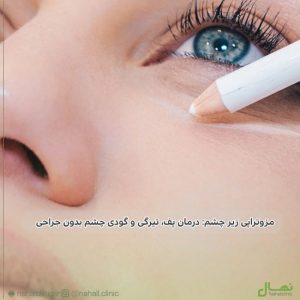 مزوتراپی زیر چشم: درمان پف، تیرگی و گودی چشم بدون جراحی