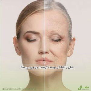 endolift-cheek-lifting