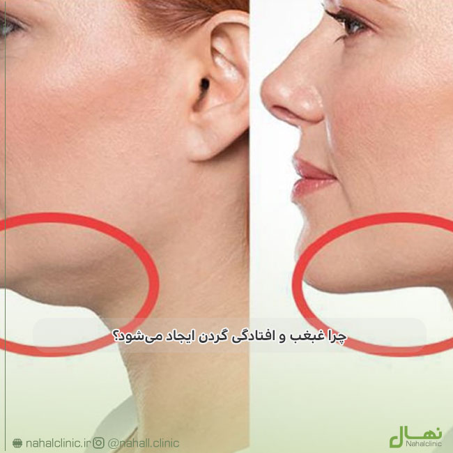 چرا غبغب و افتادگی گردن ایجاد میشود؟