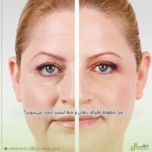 خطوط اطراف دهان و خط لبخند