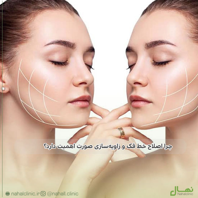 چرا اصلاح خط فک و زاویهسازی صورت اهمیت دارد؟