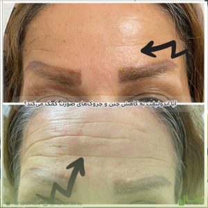 اندولیفت به کاهش چین و چروک‌ها