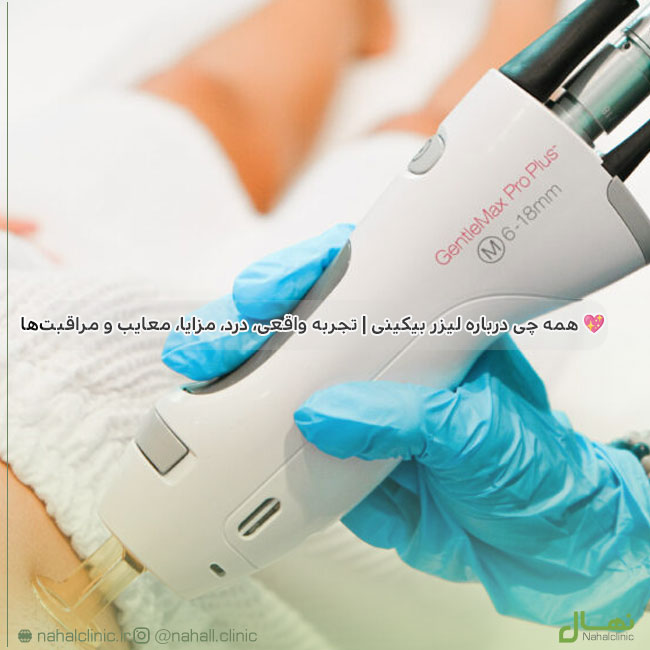 لیزر بیکینی