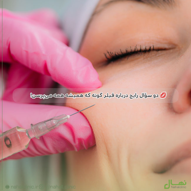 فیلر گونه