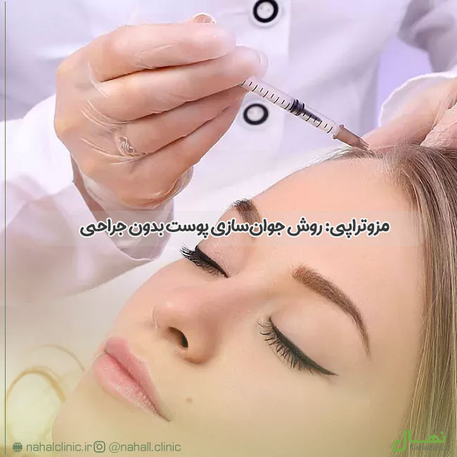مزوتراپی
