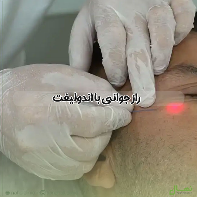 راز جوانی با اندولیفت
