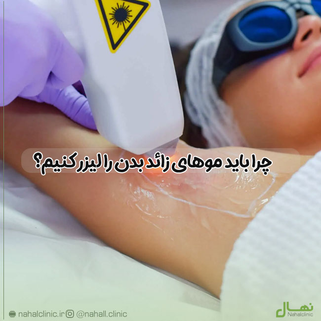 چرا باید موهای زائد بدن را لیزر کنیم؟