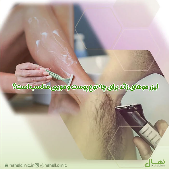laser-moohaye-zaed-baraye-che-noe-poost-va-mooei-monaseb-ast