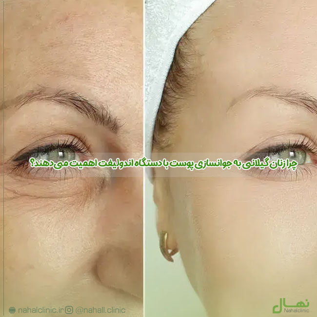 چرا زنان گیلانی به جوانسازی پوست با دستگاه اندولیفت اهمیت می‌دهند؟