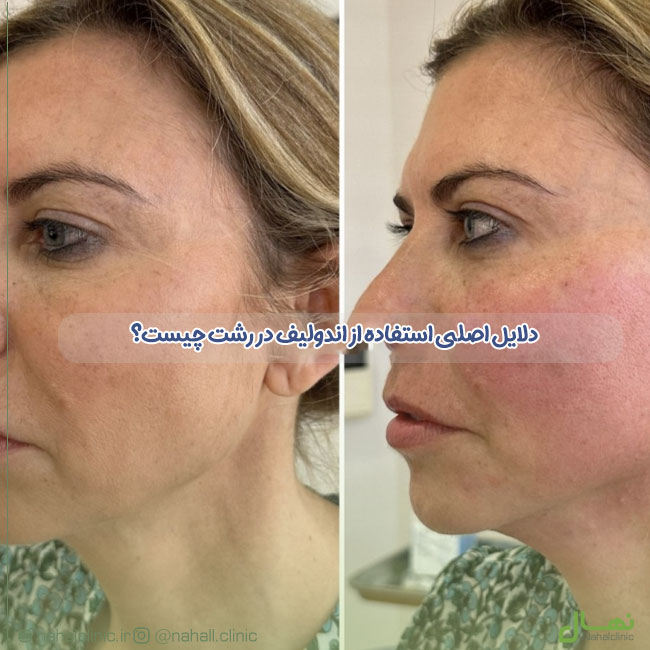 دلایل اصلی استفاده از اندولیف پوست در رشت