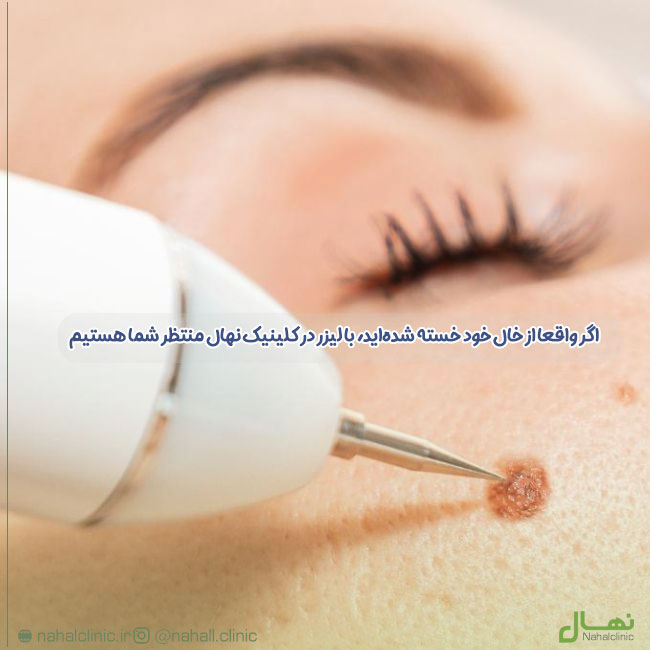 اگر واقعا از خال خود خسته شدهاید، با لیزر در کلینیک نهال منتظر شما هستیم