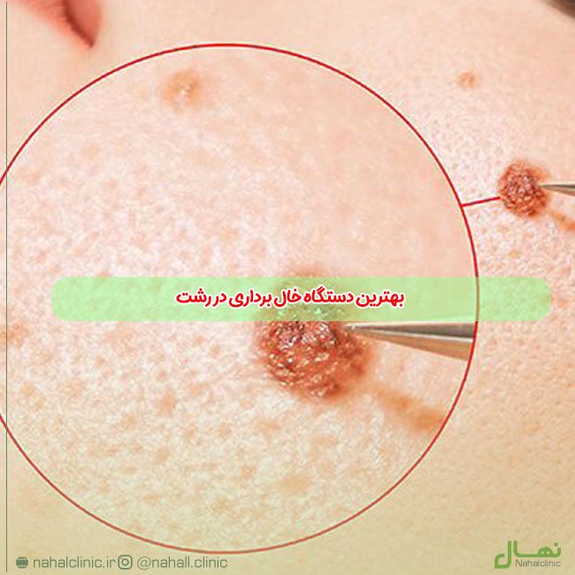 بهترین دستگاه خال برداری در رشت | کلینیک زیبایی نهال