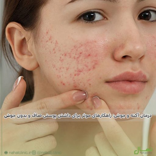 درمان آکنه و جوش