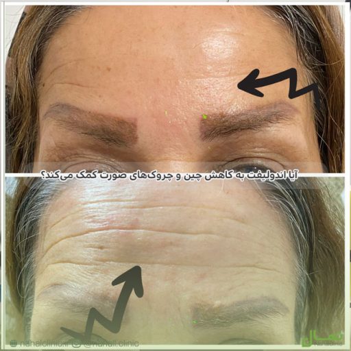 اندولیفت به کاهش چین و چروک‌ها