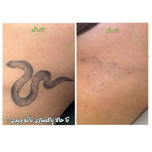 پاکسازی کامل تاتو