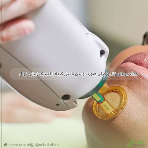 حذف موهای زائد و کرکی صورت و بدن با لیزر کندلا | کلینیک زیبایی نهال