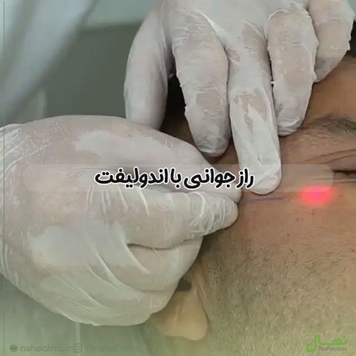 راز جوانی با اندولیفت