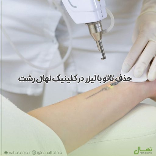حذف تاتو با لیزر
