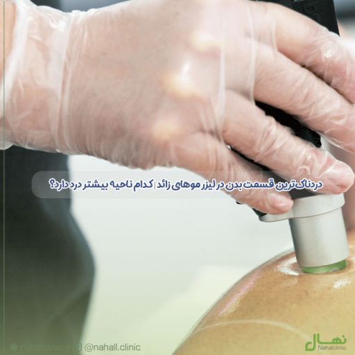 دردناک‌ترین قسمت بدن در لیزر موهای زائد | کدام ناحیه بیشتر درد دارد؟