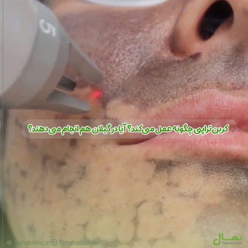 کربن‌تراپی چیست و چگونه عمل می‌کند؟