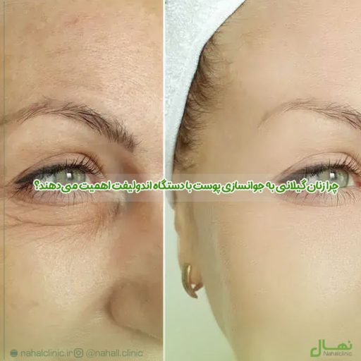 چرا زنان گیلانی به جوانسازی پوست با دستگاه اندولیفت اهمیت می‌دهند؟