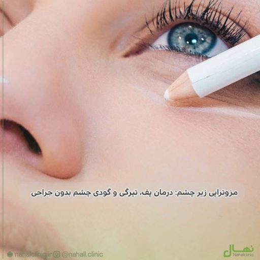 مزوتراپی زیر چشم: درمان پف، تیرگی و گودی چشم بدون جراحی