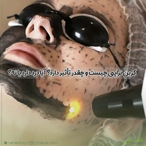 کربن تراپی چیست