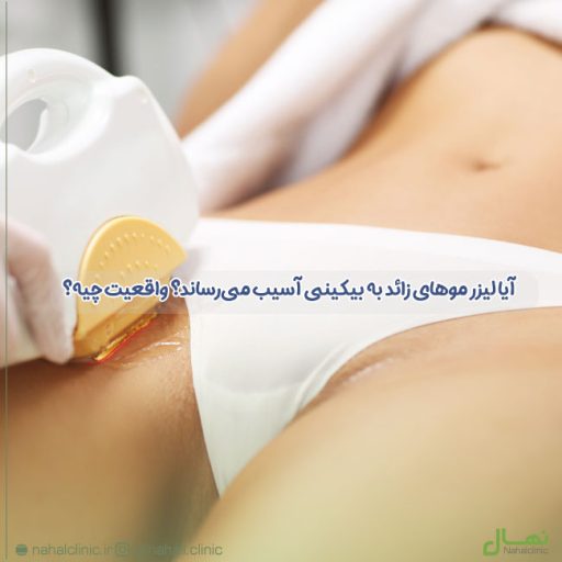 آیا لیزر موهای زائد به بیکینی آسیب می‌رساند؟ واقعیت چیه؟