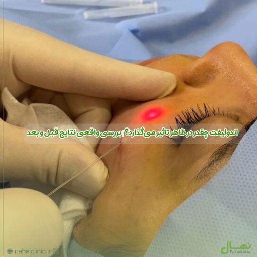 اندولیفت چقدر در ظاهر تاثیر می‌گذارد؟ | بررسی واقعی نتایج قبل و بعد