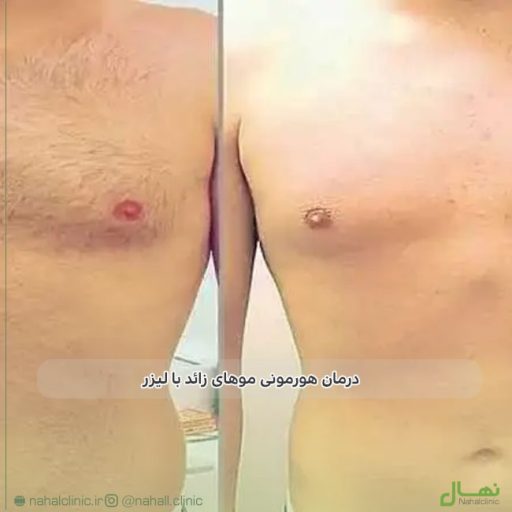 درمان هورمونی موهای زائد با لیزر