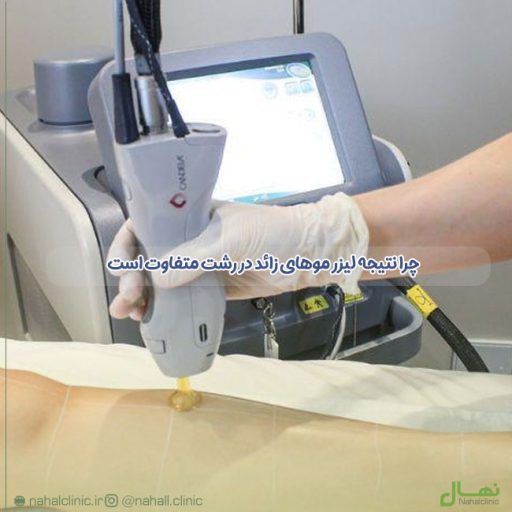 چرا نتیجه لیزر موهای زائد در رشت متفاوت است