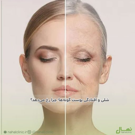 endolift-cheek-lifting