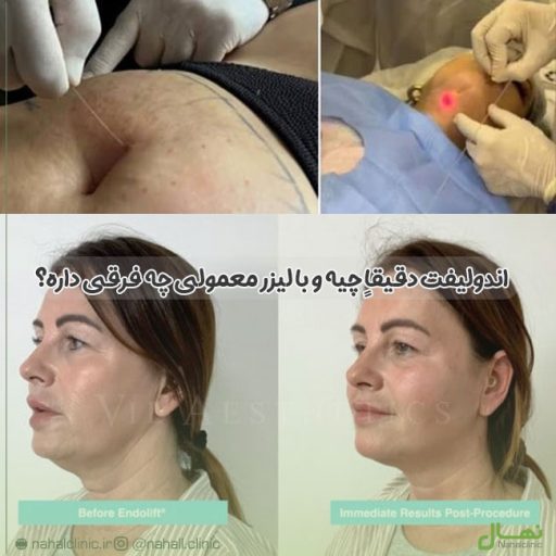 /endolift-vs-laser-چیست-تفاوت