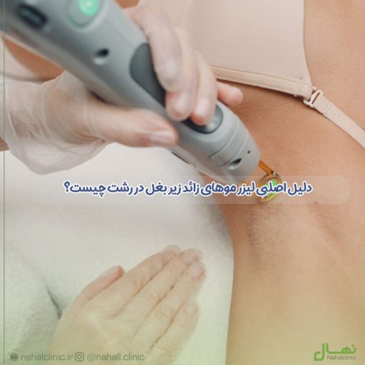لیزر موهای زائد زیر بغل در رشت