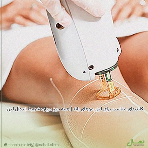 کاندیدای مناسب برای لیزر موهای زائد