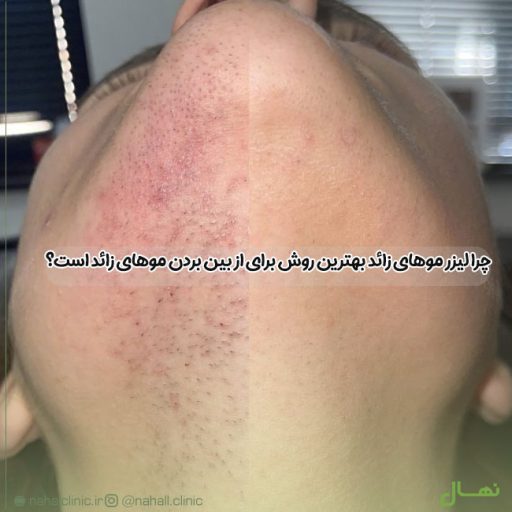 چرا لیزر موهای زائد بهترین روش برای از بین بردن موهای زائد است؟