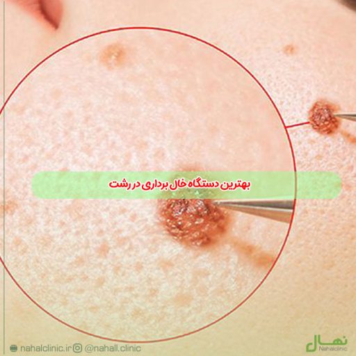 بهترین دستگاه خال برداری در رشت | کلینیک زیبایی نهال