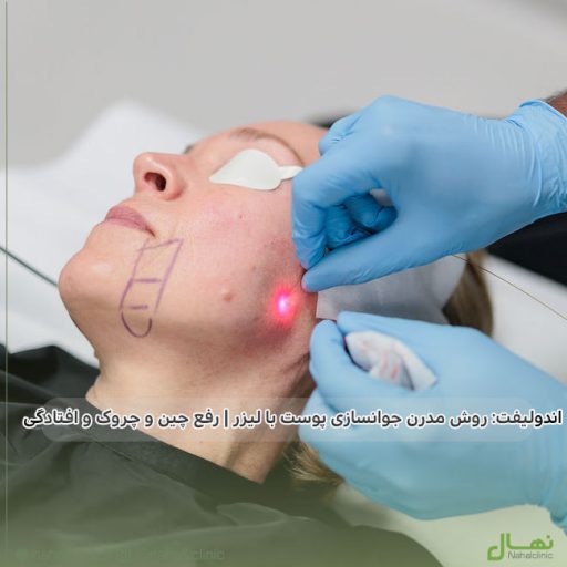 لیزر اندولیفت